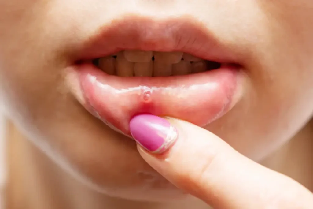 ip piercing is nesting or embedding